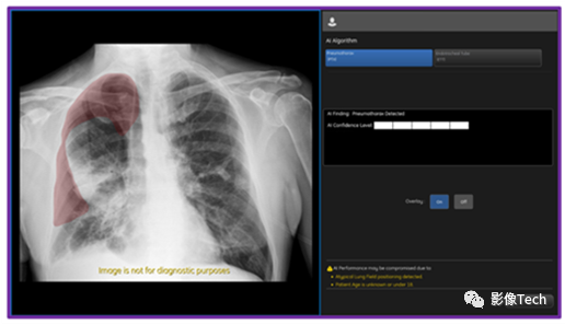 GE醫(yī)療氣胸AI算法獲批FDA！準(zhǔn)確率高達(dá)100%