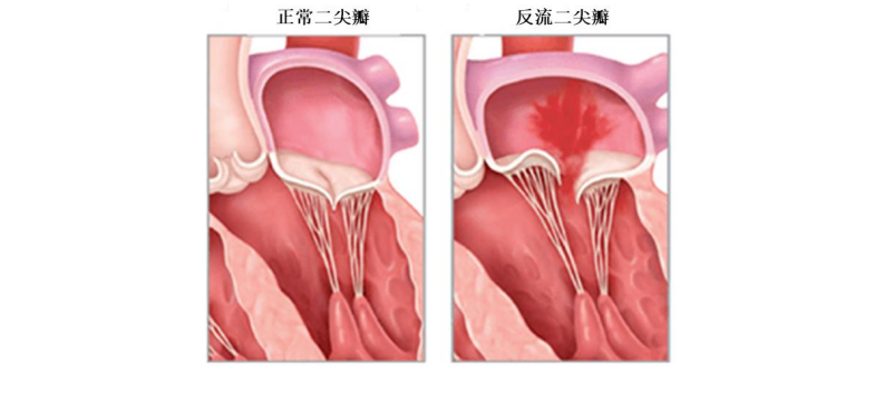 對(duì)標(biāo)雅培，國產(chǎn)二尖瓣獨(dú)角獸沖刺科創(chuàng)板